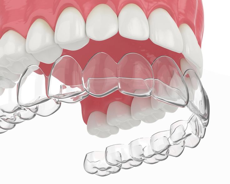 Invisalign clear aligners used for orthodontic treatment