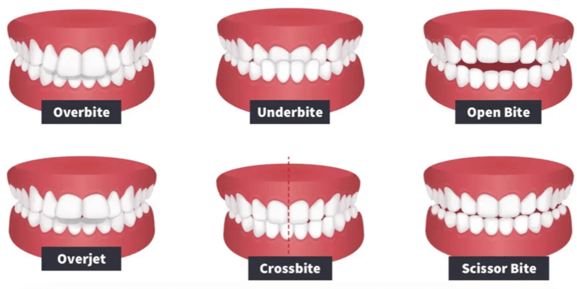 Orthodontic treatment improves bite alignment and oral health