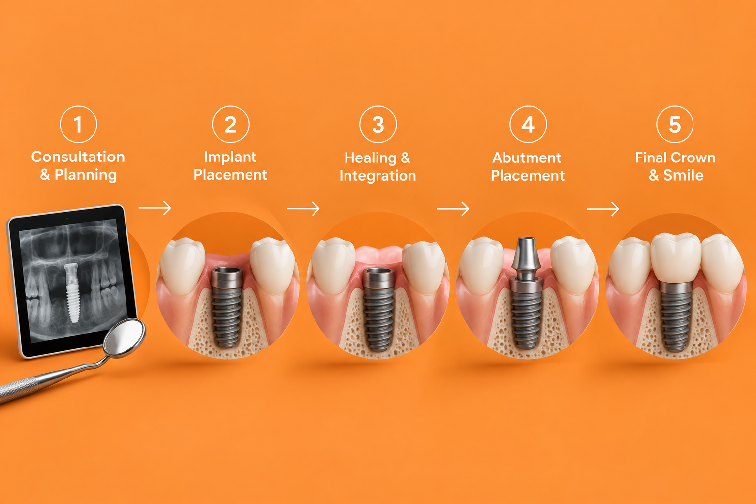 Dental implant process showing consultation, implant placement, healing, abutment placement, and final crown