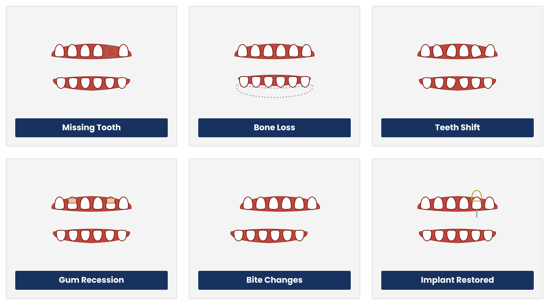 Illustration showing possible effects of a missing tooth, including bone loss, teeth shifting, and bite changes